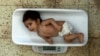 A malnourished baby is weighed at the Indira Gandhi Hospital in Kabul. (file photo)