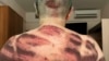 Novaya gazeta journalist Yelena Milashina shows her bruised back after receiving medical treatment in Moscow on July 5. She said around 10 to 15 attackers beat her with plastic pipes.